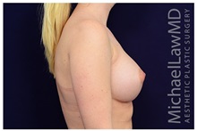 Breast Augmentation After Photo by Michael Law, MD; Raleigh, NC - Case 33222
