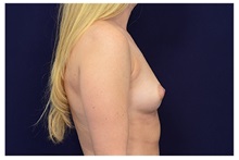 Breast Augmentation Before Photo by Michael Law, MD; Raleigh, NC - Case 33222
