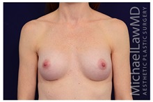 Breast Augmentation After Photo by Michael Law, MD; Raleigh, NC - Case 33224