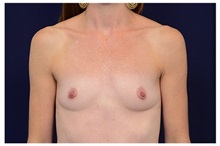Breast Augmentation Before Photo by Michael Law, MD; Raleigh, NC - Case 33224