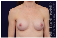 Breast Augmentation After Photo by Michael Law, MD; Raleigh, NC - Case 33224