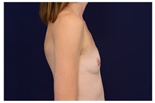 Breast Augmentation Before Photo by Michael Law, MD; Raleigh, NC - Case 33224
