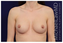 Breast Augmentation After Photo by Michael Law, MD; Raleigh, NC - Case 33225