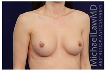 Breast Augmentation After Photo by Michael Law, MD; Raleigh, NC - Case 33225