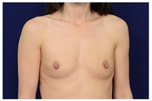 Breast Augmentation Before Photo by Michael Law, MD; Raleigh, NC - Case 33225