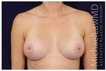 Breast Augmentation After Photo by Michael Law, MD; Raleigh, NC - Case 33227