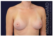 Breast Augmentation After Photo by Michael Law, MD; Raleigh, NC - Case 33227