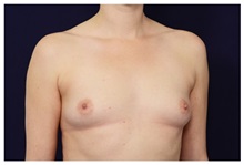 Breast Augmentation Before Photo by Michael Law, MD; Raleigh, NC - Case 33227
