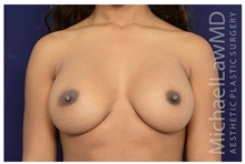 Breast Augmentation After Photo by Michael Law, MD; Raleigh, NC - Case 33229