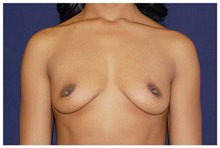 Breast Augmentation Before Photo by Michael Law, MD; Raleigh, NC - Case 33229