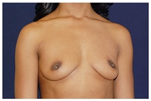 Breast Augmentation Before Photo by Michael Law, MD; Raleigh, NC - Case 33229