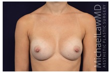 Breast Augmentation After Photo by Michael Law, MD; Raleigh, NC - Case 33230