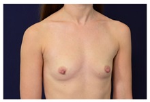 Breast Augmentation Before Photo by Michael Law, MD; Raleigh, NC - Case 33230