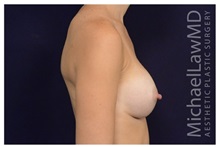 Breast Augmentation After Photo by Michael Law, MD; Raleigh, NC - Case 33230