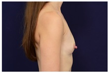 Breast Augmentation Before Photo by Michael Law, MD; Raleigh, NC - Case 33230