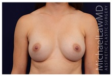 Breast Augmentation After Photo by Michael Law, MD; Raleigh, NC - Case 33232