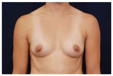 Breast Augmentation Before Photo by Michael Law, MD; Raleigh, NC - Case 33232