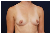 Breast Augmentation Before Photo by Michael Law, MD; Raleigh, NC - Case 33232