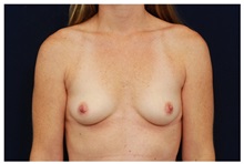 Breast Augmentation Before Photo by Michael Law, MD; Raleigh, NC - Case 33234