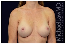 Breast Augmentation After Photo by Michael Law, MD; Raleigh, NC - Case 33234