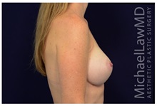 Breast Augmentation After Photo by Michael Law, MD; Raleigh, NC - Case 33234