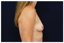 Breast Augmentation Before Photo by Michael Law, MD; Raleigh, NC - Case 33234