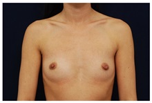 Breast Augmentation Before Photo by Michael Law, MD; Raleigh, NC - Case 33235