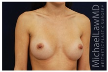 Breast Augmentation After Photo by Michael Law, MD; Raleigh, NC - Case 33235
