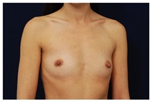 Breast Augmentation Before Photo by Michael Law, MD; Raleigh, NC - Case 33235