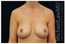 Breast Augmentation After Photo by Michael Law, MD; Raleigh, NC - Case 33237