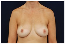 Breast Augmentation Before Photo by Michael Law, MD; Raleigh, NC - Case 33237