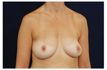 Breast Augmentation Before Photo by Michael Law, MD; Raleigh, NC - Case 33237