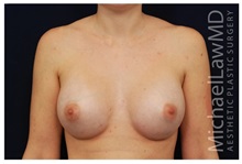 Breast Augmentation After Photo by Michael Law, MD; Raleigh, NC - Case 33238