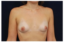 Breast Augmentation Before Photo by Michael Law, MD; Raleigh, NC - Case 33238
