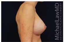 Breast Augmentation After Photo by Michael Law, MD; Raleigh, NC - Case 33238
