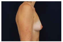 Breast Augmentation Before Photo by Michael Law, MD; Raleigh, NC - Case 33238