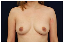 Breast Augmentation Before Photo by Michael Law, MD; Raleigh, NC - Case 33239