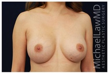 Breast Augmentation After Photo by Michael Law, MD; Raleigh, NC - Case 33239