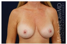 Breast Augmentation After Photo by Michael Law, MD; Raleigh, NC - Case 33241