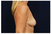 Breast Augmentation Before Photo by Michael Law, MD; Raleigh, NC - Case 33241
