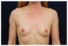 Breast Augmentation Before Photo by Michael Law, MD; Raleigh, NC - Case 33243