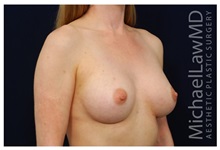 Breast Augmentation After Photo by Michael Law, MD; Raleigh, NC - Case 33243