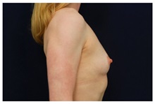 Breast Augmentation Before Photo by Michael Law, MD; Raleigh, NC - Case 33243