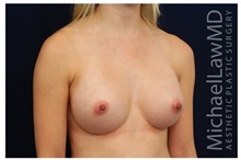Breast Augmentation After Photo by Michael Law, MD; Raleigh, NC - Case 33244
