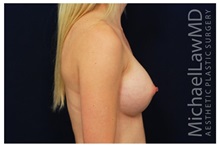 Breast Augmentation After Photo by Michael Law, MD; Raleigh, NC - Case 33244