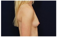 Breast Augmentation Before Photo by Michael Law, MD; Raleigh, NC - Case 33244
