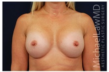 Breast Augmentation After Photo by Michael Law, MD; Raleigh, NC - Case 33245