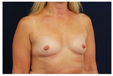 Breast Augmentation Before Photo by Michael Law, MD; Raleigh, NC - Case 33245