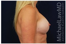 Breast Augmentation After Photo by Michael Law, MD; Raleigh, NC - Case 33245