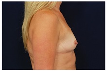 Breast Augmentation Before Photo by Michael Law, MD; Raleigh, NC - Case 33245